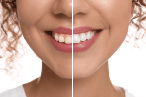 teeth whitening