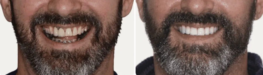 Tooth Crown Before and After: The Dramatic Difference
