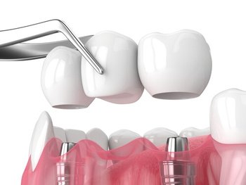 Dental Bridge Cost implant supported