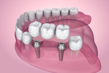 Dental Bridge Cost procedure