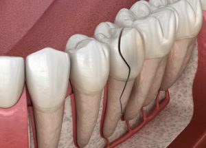 Types of Root Canals use
