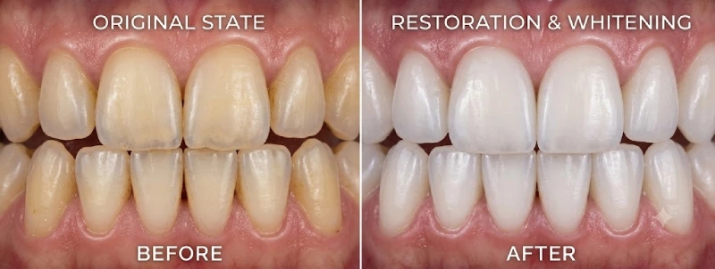 Whitening Duration and Maintenance