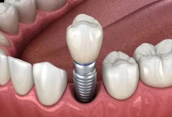 Dental implants Sydney