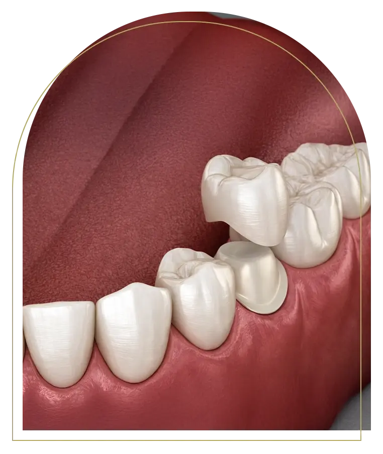 Porcelain Crowns