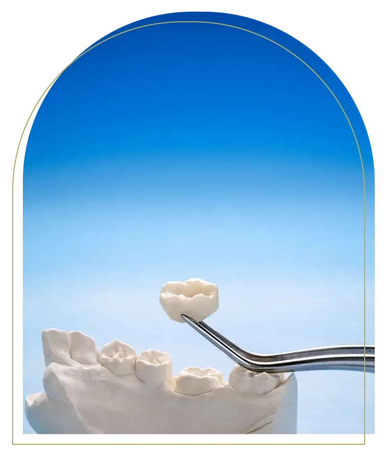 Composite Veneers for a Perfect Smile