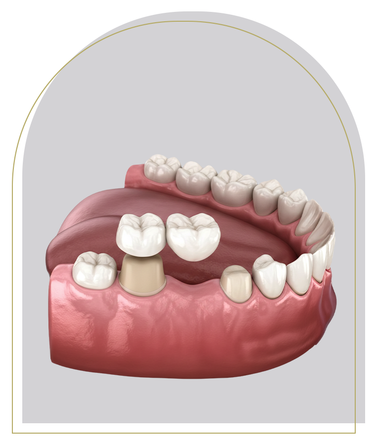 Ceramic Crowns