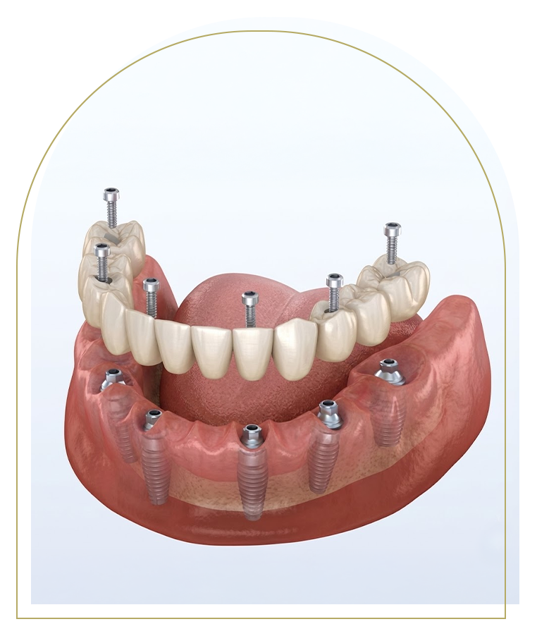 All-on-4 Dental Implants: Complete Smile Restoration in One Day