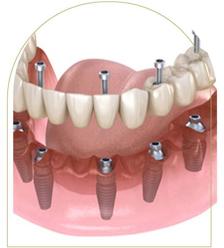 All-on-4 Dental Implants: Complete Smile Restoration in One Day