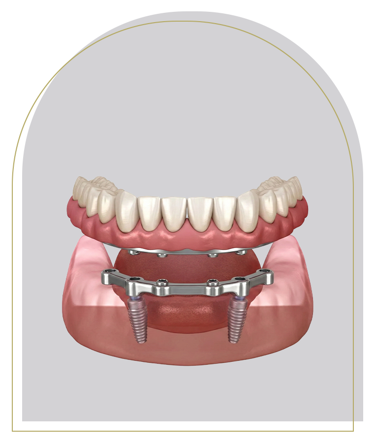 Implant-Retained Dentures