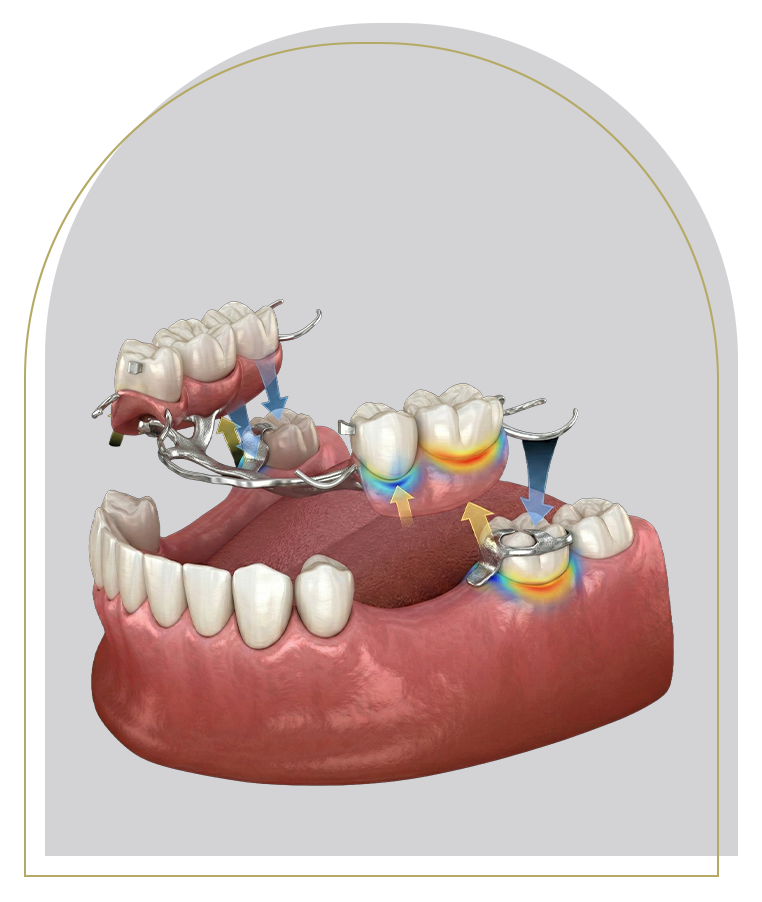 Partial Dentures