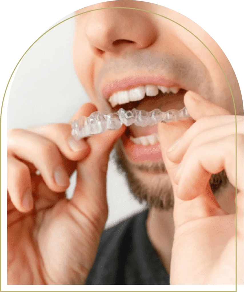 Clear aligner orthodontic treatment before veneers – what are porcelain veneers smile solution