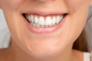 what are composite veneers