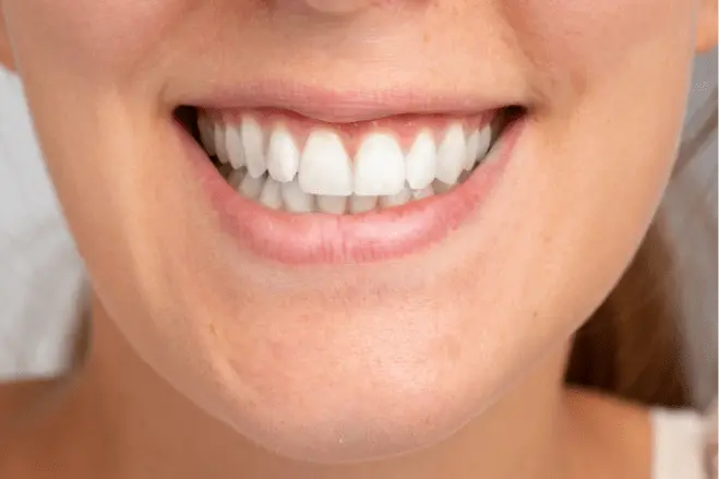 what are composite veneers