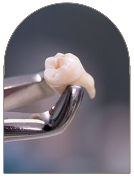 Surgical Extractions (Impacted Teeth)