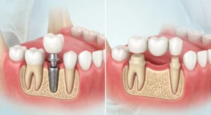 Tooth Implant vs Dental Bridge
