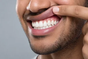 Can You Exercise After a Dental Implant?