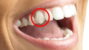 What Are Cuspid Teeth?