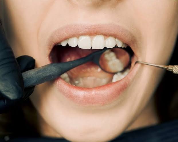 Why a Dental Implant Can’t Get a Cavity