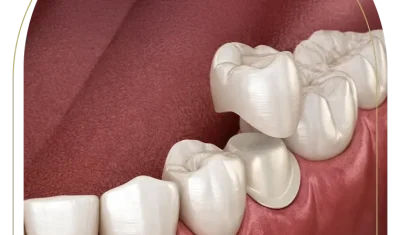 Porcelain Crowns