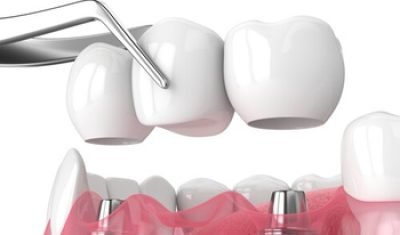 Dental Bridge Cost implant supported