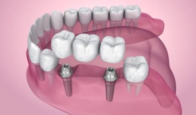 Dental Bridge Cost procedure