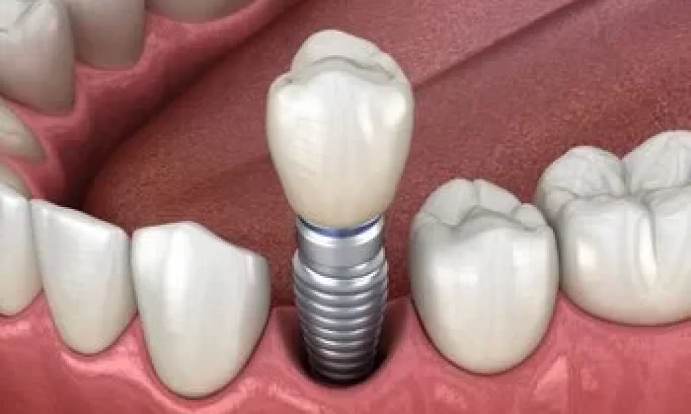 Dental implants Sydney