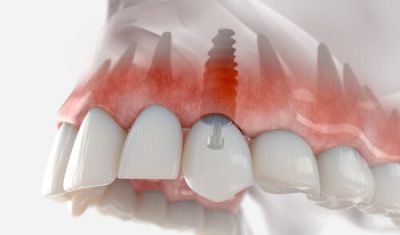 dental implant thailand illustration